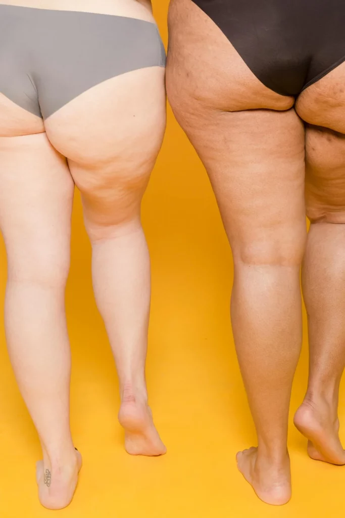 Feature image lipedema sintomas